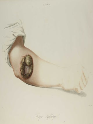 Traité des syphilides ou maladies vénériennes de la peau, precedee de considerations sur la syphilis, son origine, sa nature etc.