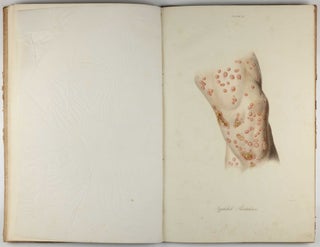 Traité des syphilides ou maladies vénériennes de la peau, precedee de considerations sur la syphilis, son origine, sa nature etc.