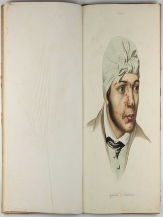 Traité des syphilides ou maladies vénériennes de la peau, precedee de considerations sur la syphilis, son origine, sa nature etc.