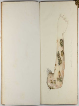 Traité des syphilides ou maladies vénériennes de la peau, precedee de considerations sur la syphilis, son origine, sa nature etc.