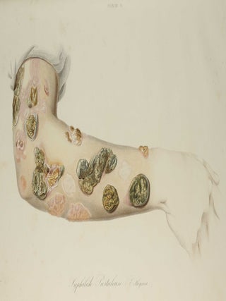 Traité des syphilides ou maladies vénériennes de la peau, precedee de considerations sur la syphilis, son origine, sa nature etc.