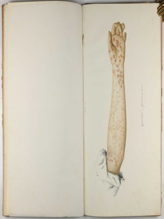 Traité des syphilides ou maladies vénériennes de la peau, precedee de considerations sur la syphilis, son origine, sa nature etc.