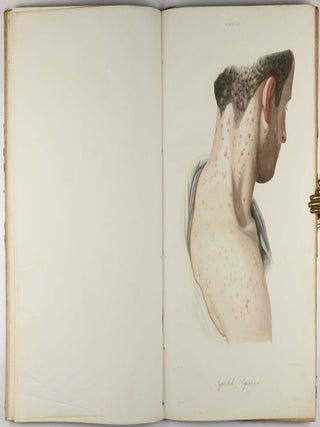 Traité des syphilides ou maladies vénériennes de la peau, precedee de considerations sur la syphilis, son origine, sa nature etc.