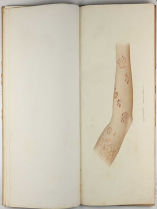Traité des syphilides ou maladies vénériennes de la peau, precedee de considerations sur la syphilis, son origine, sa nature etc.