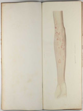Traité des syphilides ou maladies vénériennes de la peau, precedee de considerations sur la syphilis, son origine, sa nature etc.