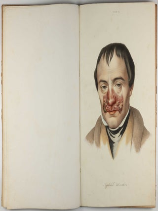 Traité des syphilides ou maladies vénériennes de la peau, precedee de considerations sur la syphilis, son origine, sa nature etc.