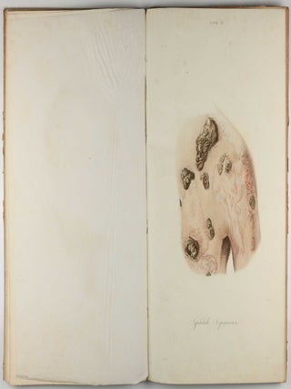 Traité des syphilides ou maladies vénériennes de la peau, precedee de considerations sur la syphilis, son origine, sa nature etc.