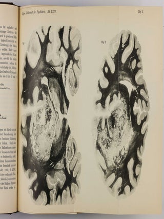 &Uuml;ber eine eigenartige Erkrankung der Hirnrinde. In: Allgemeine Zeitschrift f&uuml;r Psychiatrie und physisch-gerichtliche Medizin, Vol. 64, No 1, pp. 146-148.