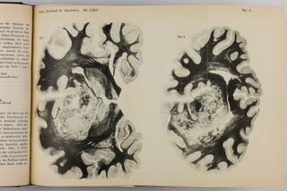Über eine eigenartige Erkrankung der Hirnrinde. In: Allgemeine Zeitschrift für Psychiatrie und physisch-gerichtliche Medizin, Vol. 64, No 1, pp. 146-148.